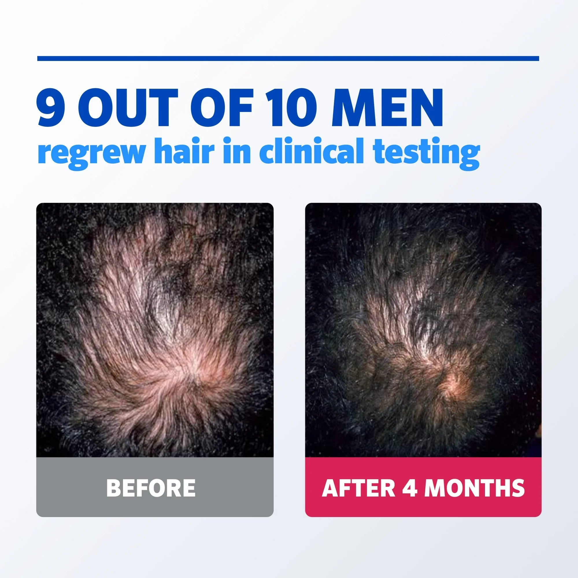 Rogaine Mens' 5% Minoxidil Foam for Hair Regrowth - 6.33oz 3-Mo Supply